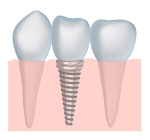 Tooth Implant Supported Dentures Look Real On Our Owensboro Patients