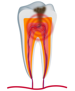 Relaxing Dental Sedation for Root Canals in Philpot