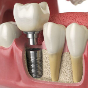 Close-up photo of a dental implant