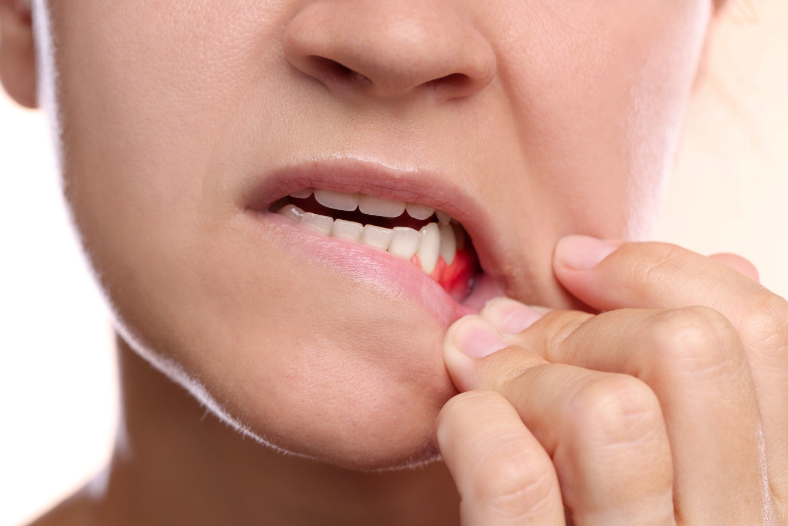 closeup of a woman pulling down her lip, exposing the early signs of gum disease